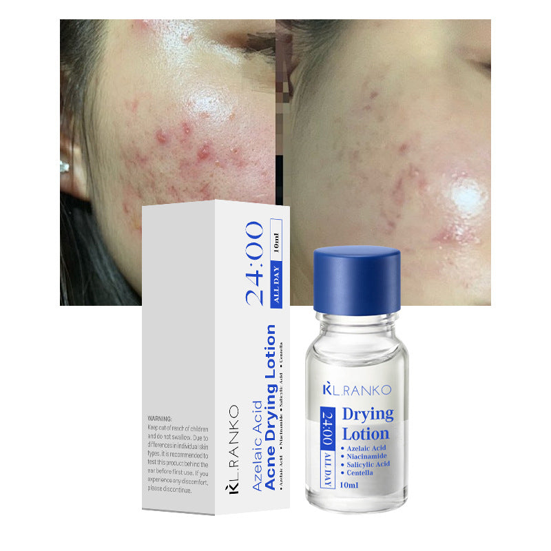 Salicylic Acid Acne Serum